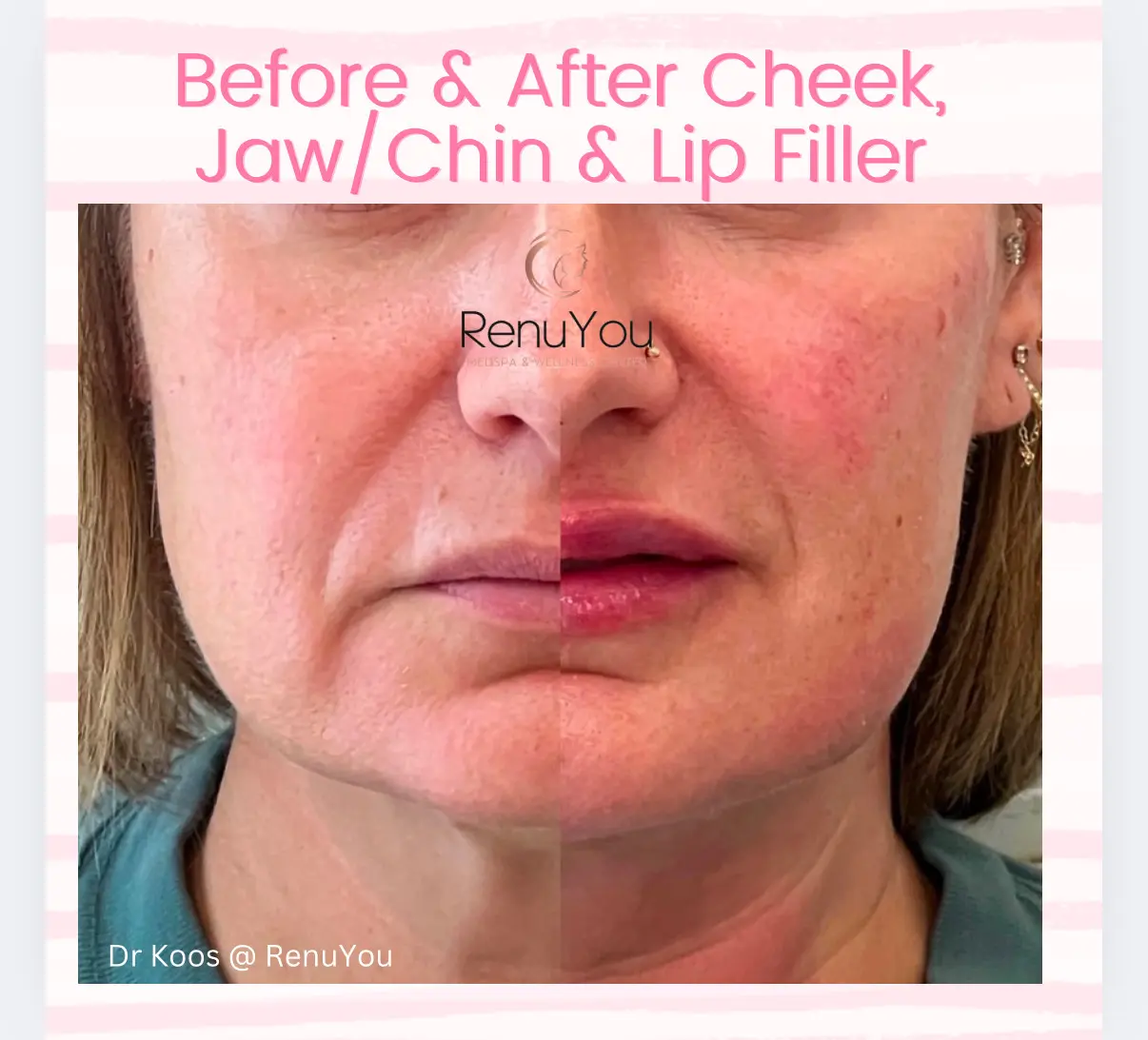 lip-cheeck-jaw-filler-ba-b-in-ames-ia