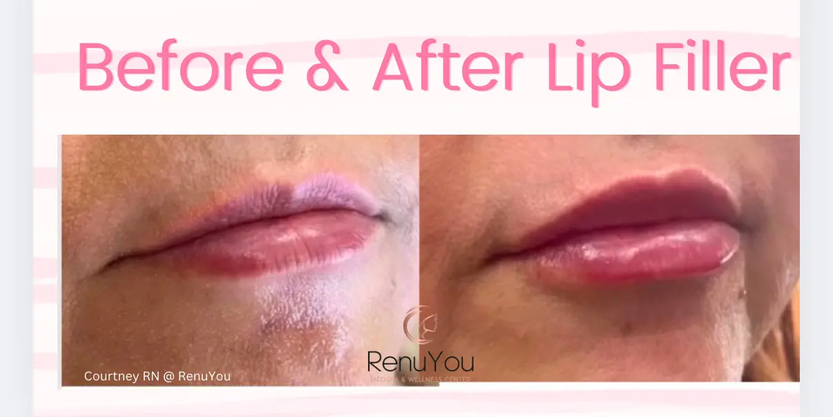lip-filler-ba-a-in-ames-ia