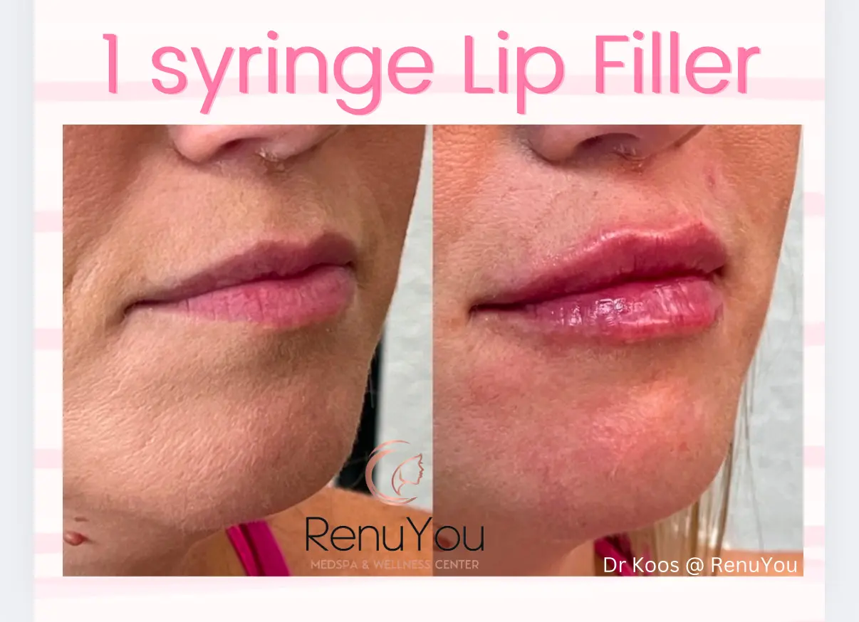 lip-filler-ba-b-in-ames-ia