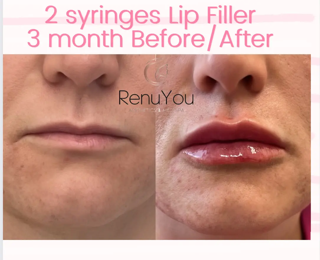 lip-filler-ba-c-in-ames-ia