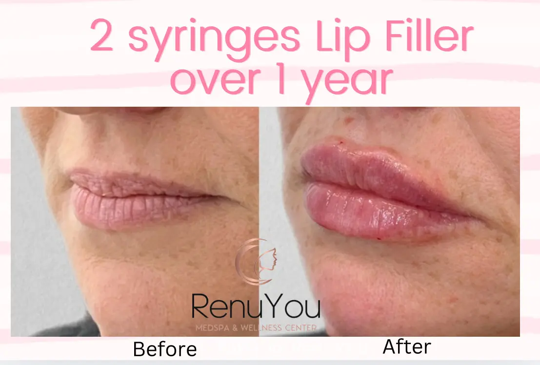 lip-filler-ba-d-in-ames-ia