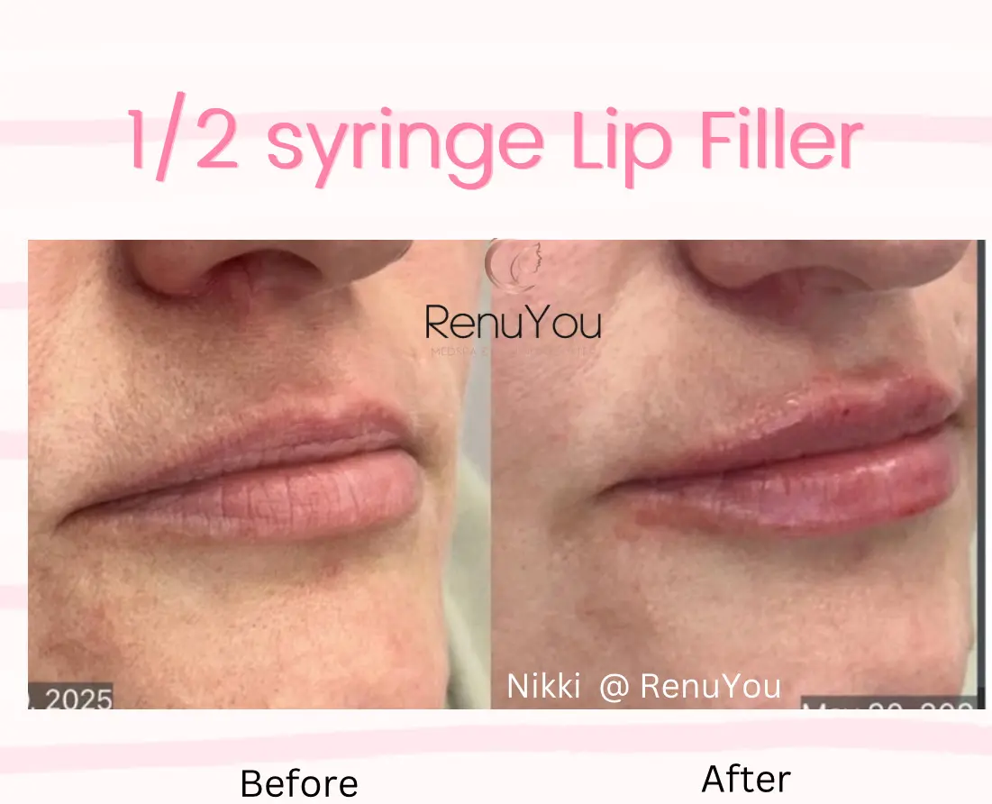 lip-filler-ba-e-in-ames-ia