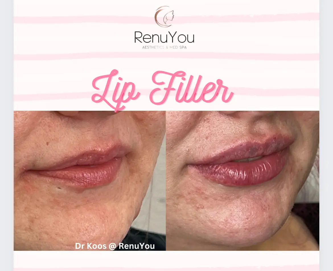 lip-filler-ba-f-in-ames-ia