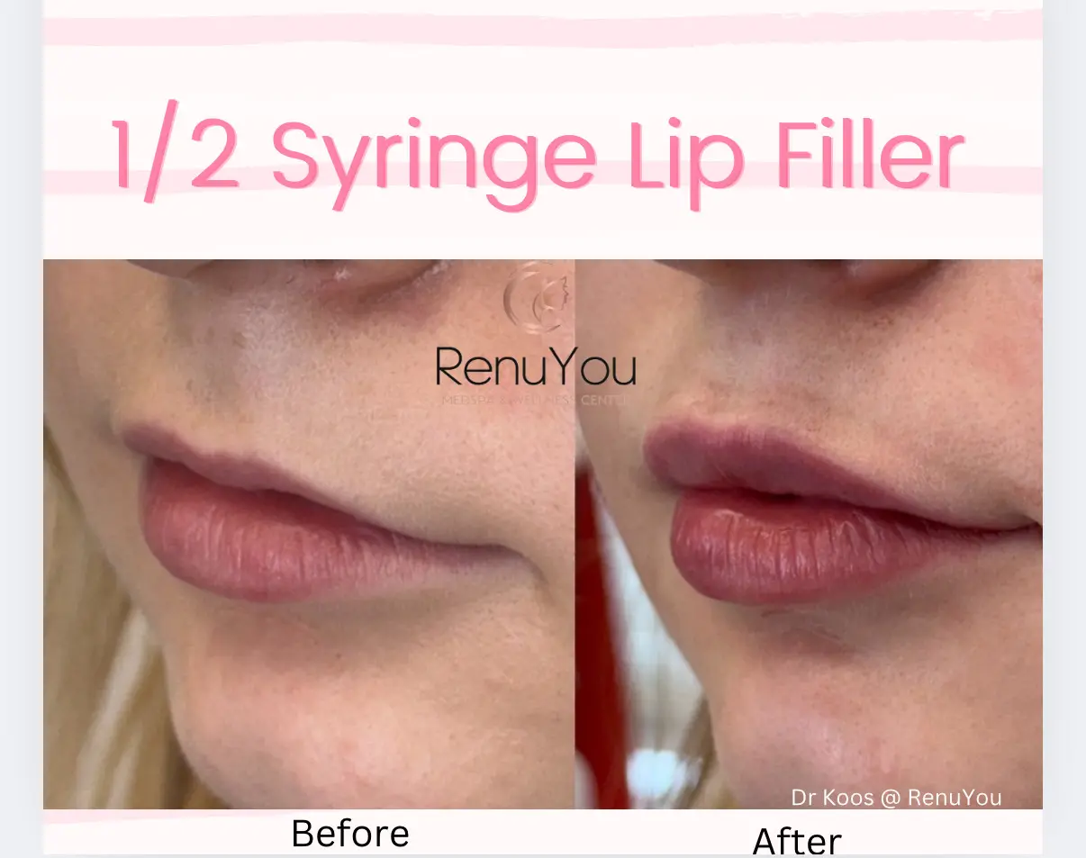 lip-filler-ba-g-in-ames-ia