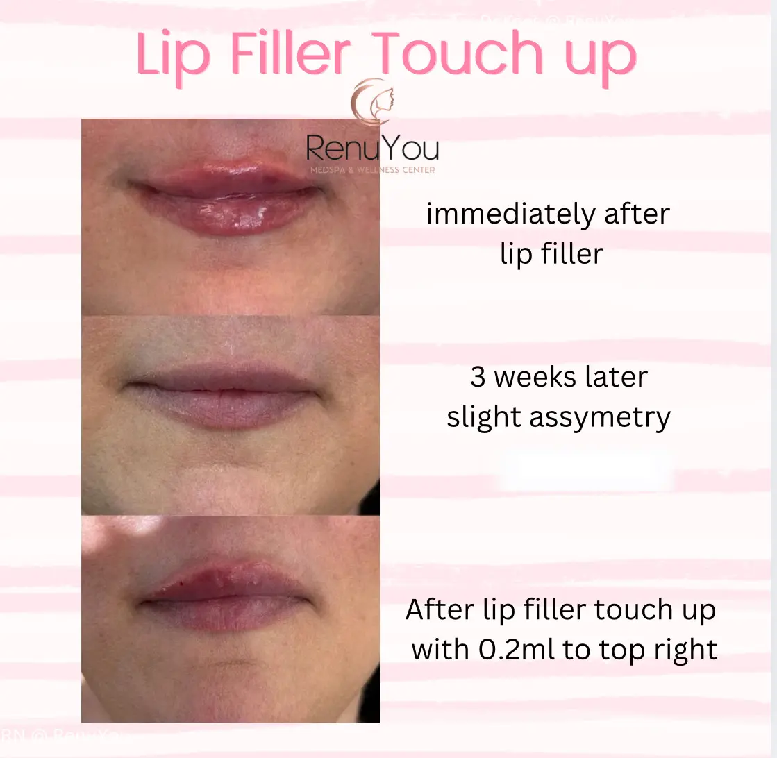 lip-filler-ba-h-in-ames-ia