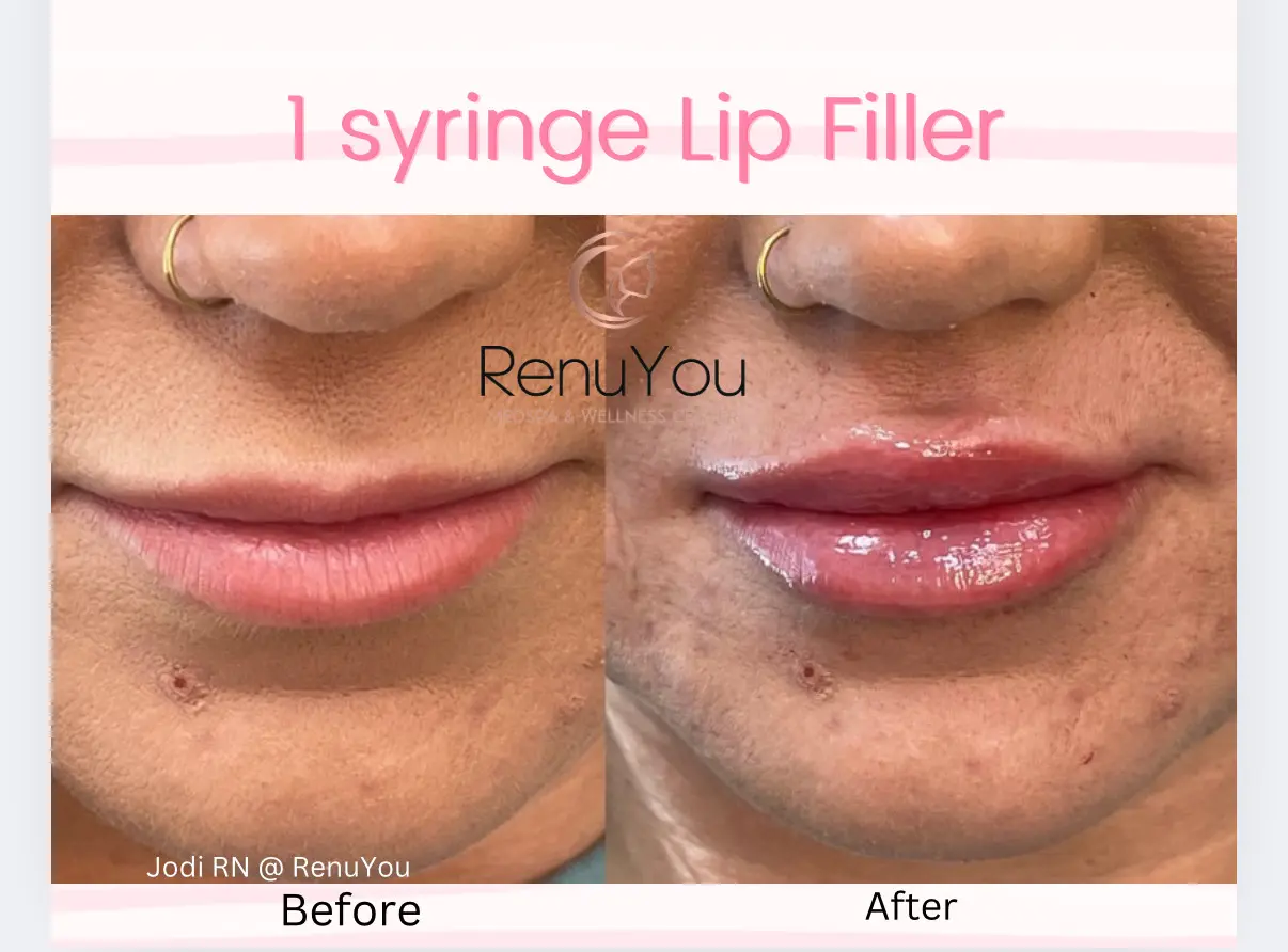 lip-filler-ba-i-in-ames-ia