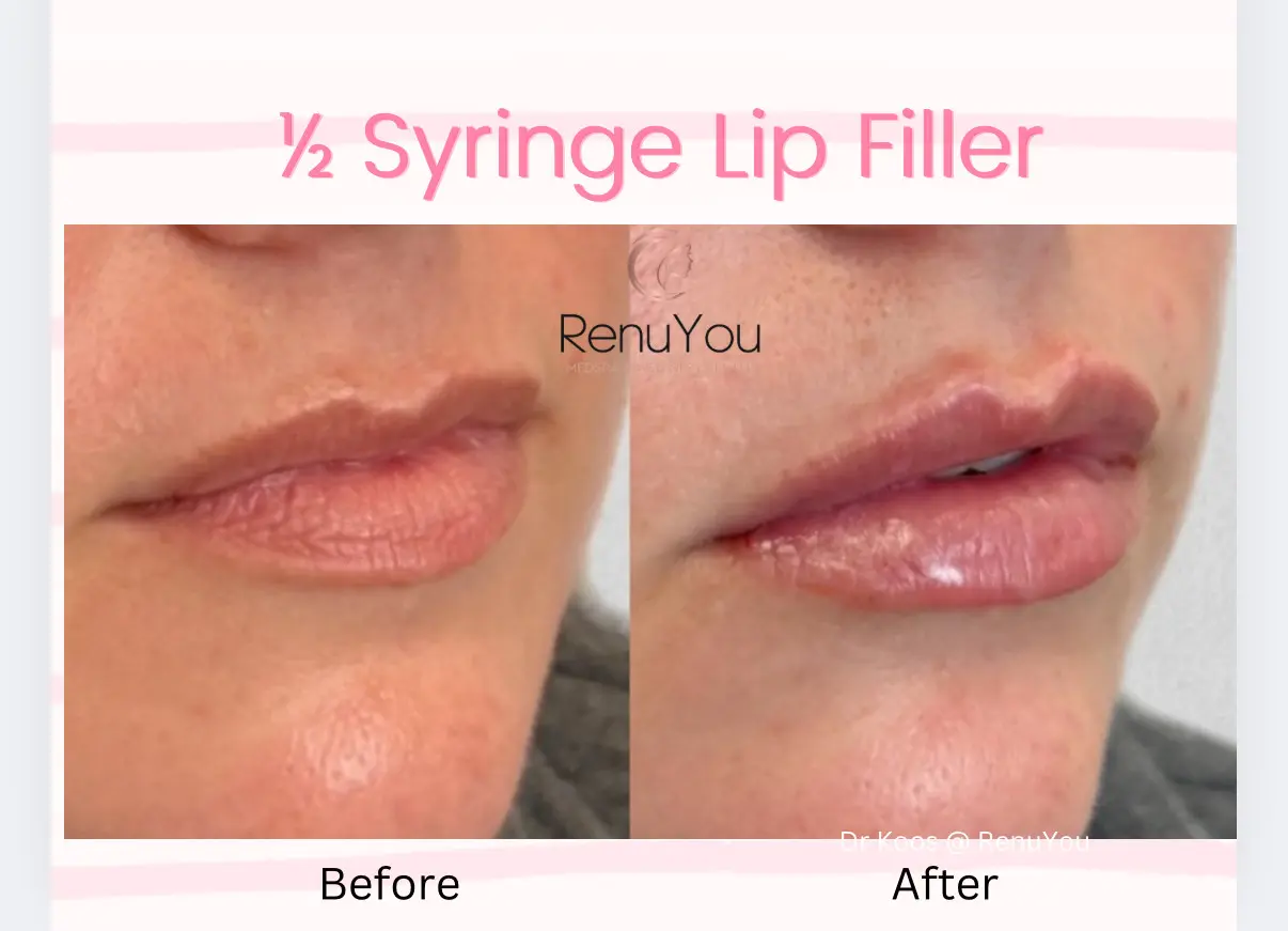 lip-filler-ba-j-in-ames-ia