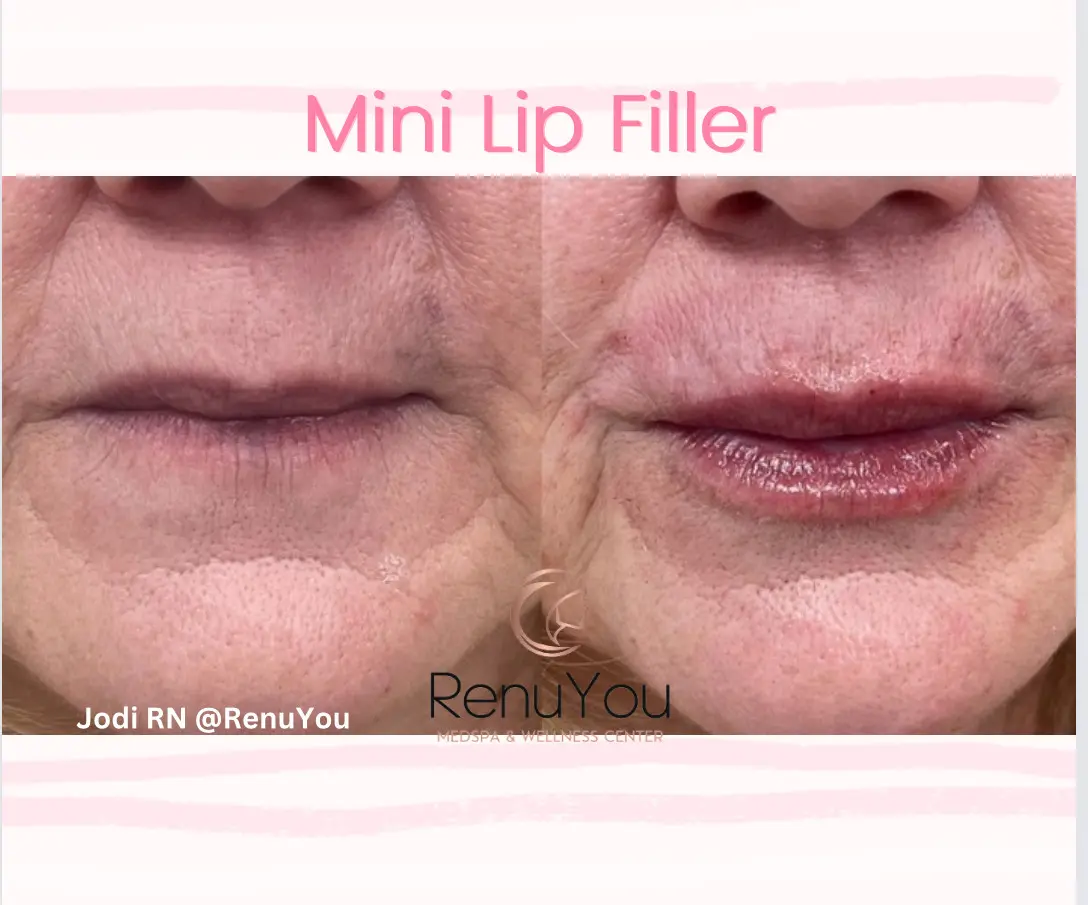mini-lip-filler-ba-a-in-ames-ia