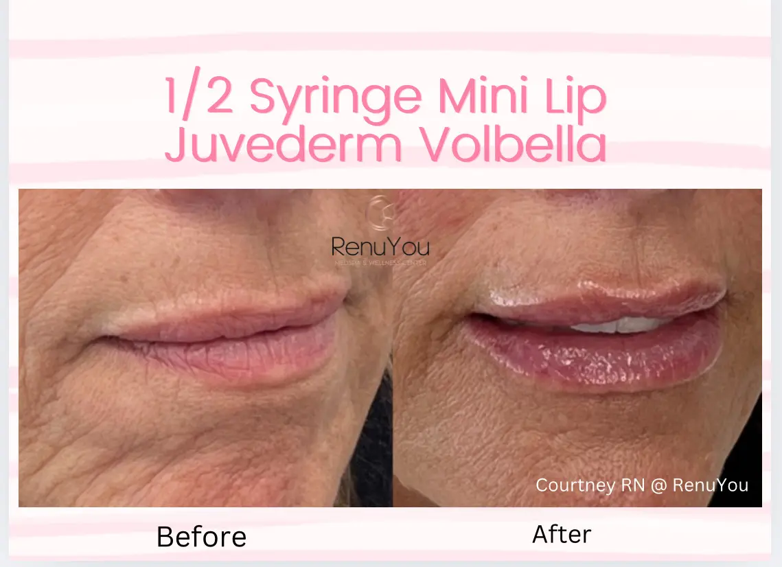 mini-lip-filler-ba-b-in-ames-ia