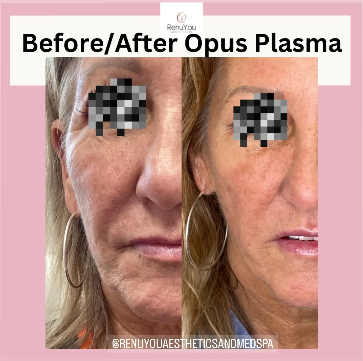 opus-plasma-ba-a-in-ames-ia