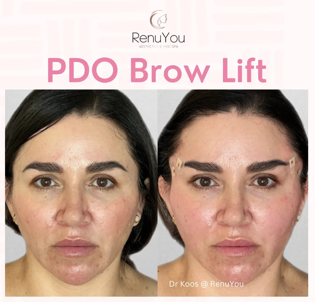 pdo-brow-ba-a-in-ames-ia
