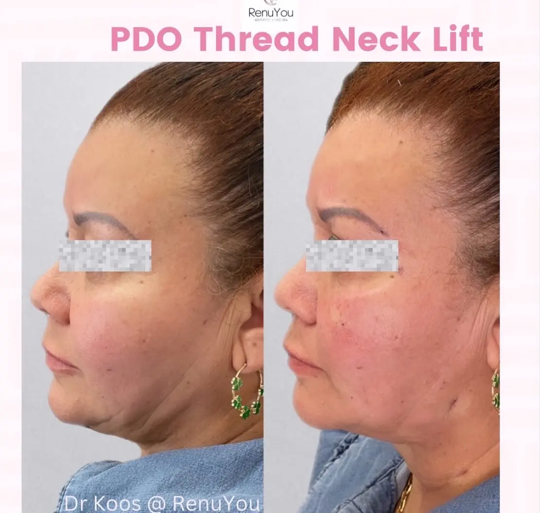 pdo-neck-ba-a-in-ames-ia