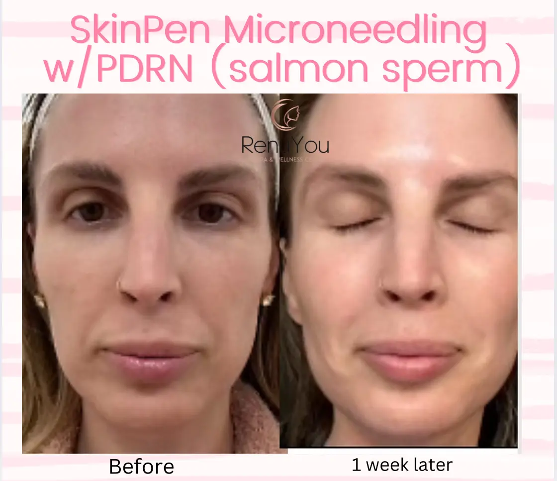 skinpen-ba-a-in-ankeny-ia