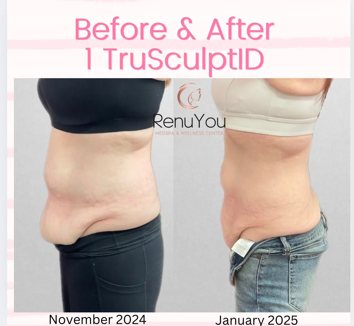 trusculpt-id-ba-a-in-ankeny-ia