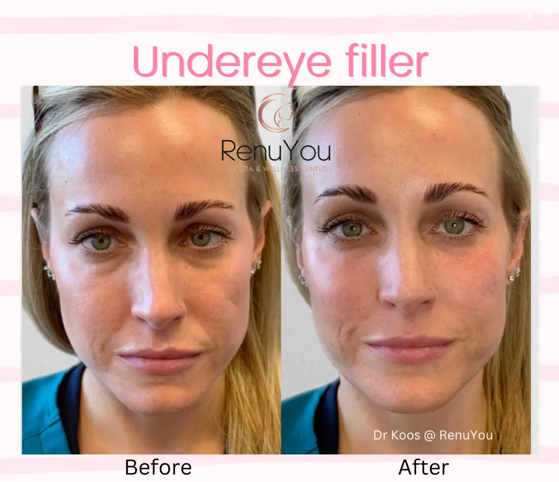 under-eye-filler-ba-a-in-ames-ia
