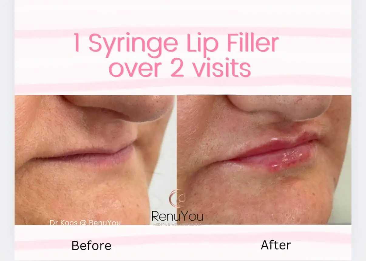 Lip Filler Before and After Results