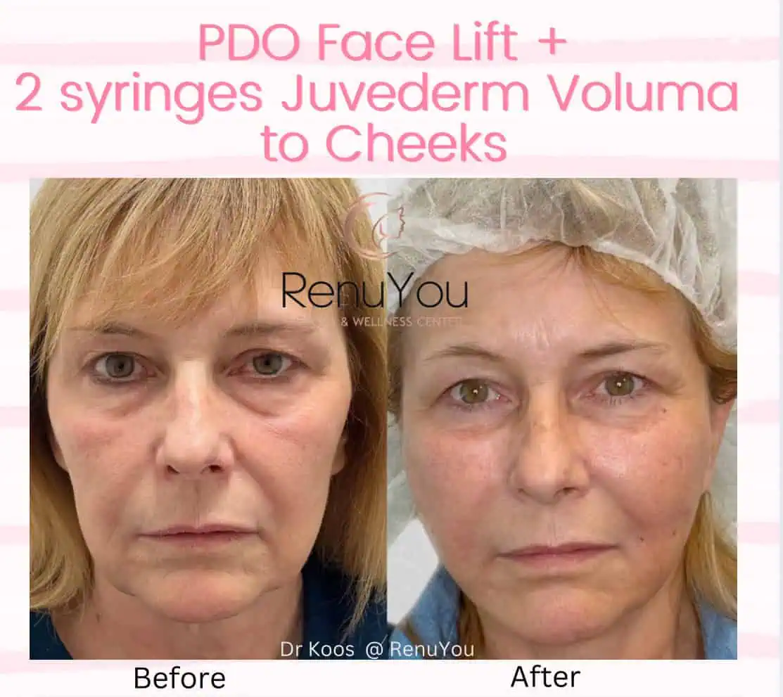 PDO Thread Lifting Before and After Results
