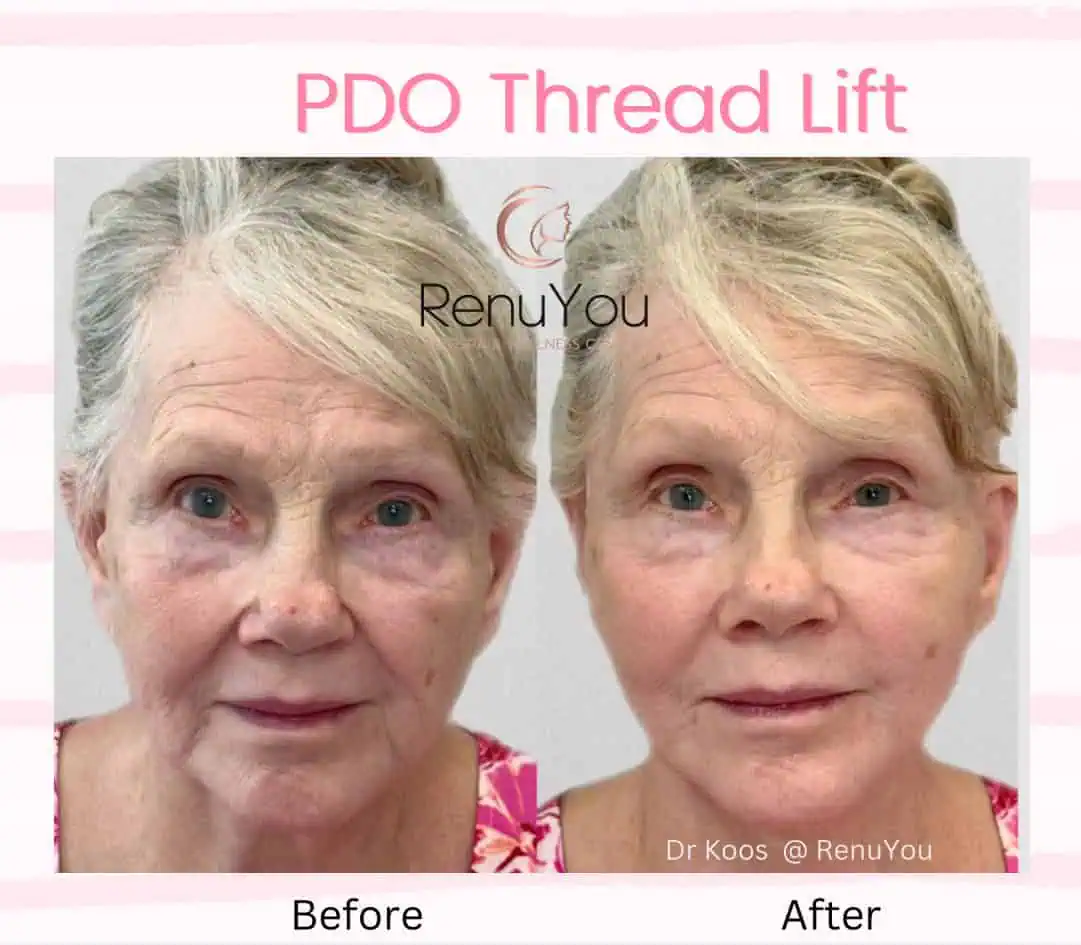 PDO Thread Lifting Before and After Results