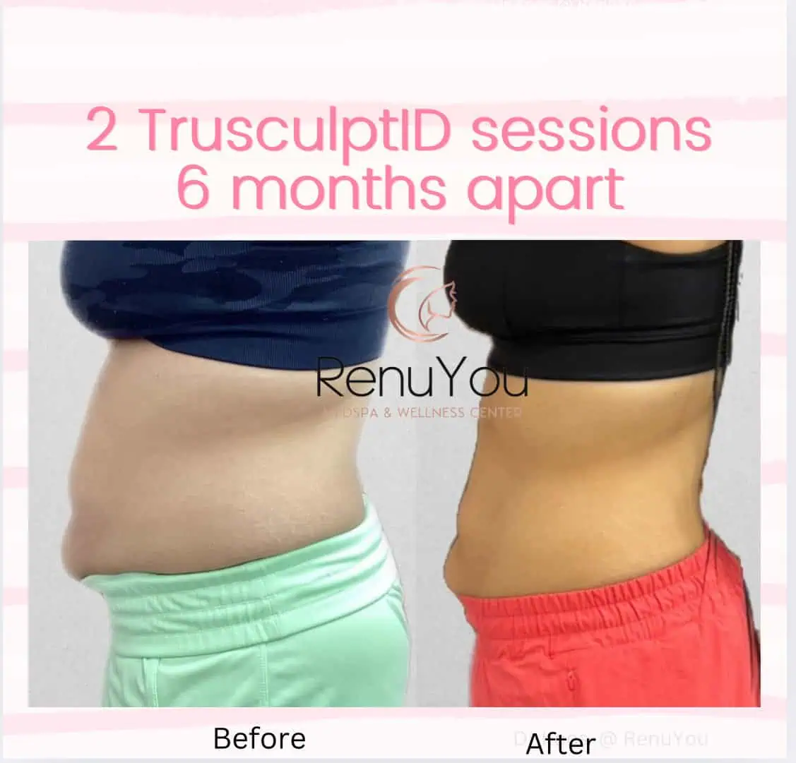 TrusculptID Before and After Results