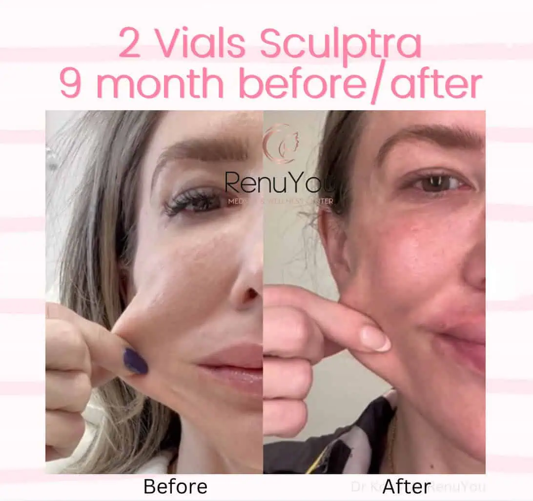Sculptra Before and After Results